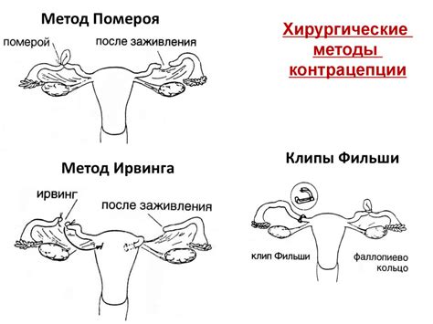 Контрацепция. Методы контрацепции - презентация онлайн
