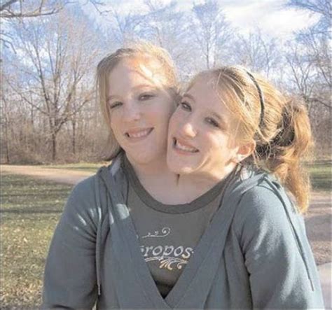 Conjoined Twins (13 pics) - Izismile.com