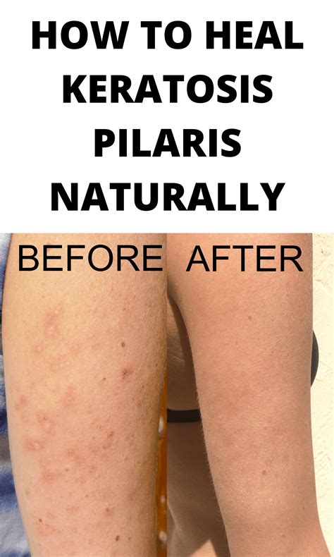 Does Hyaluronic Acid Help With Keratosis Pilaris at Virgie Foreman blog