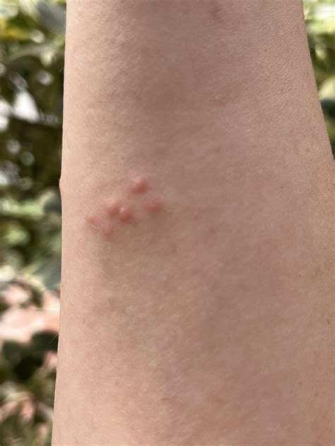 What kind of bug bite is this? : r/Thailand