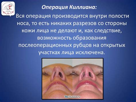 Клиническая анатомия носа. Септопластика. Ринопластика - презентация онлайн