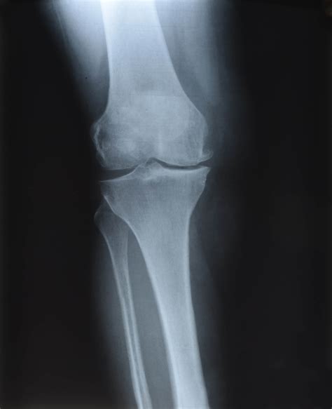 Knee Osteochondritis Dissecans - AOA Orthopedic Specialists