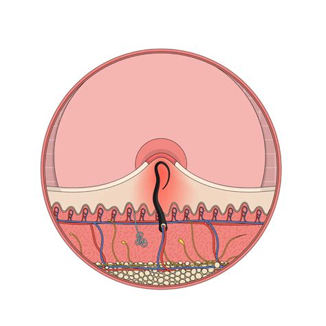 pictures of a ingrown hair cyst 5