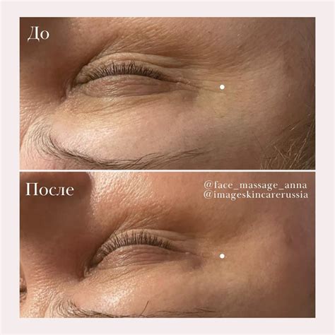 Результат 1 процедуры пилинга от морщин с ретинолом IMAGE Skincare