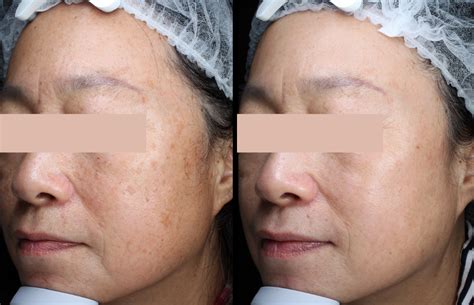 Hyperpigmentation and Dullness - 67 Degrees Cosmetic Clinic