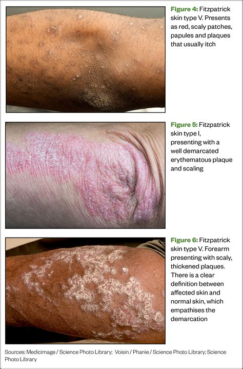 Common Skin Conditions Live Well Nhs Choices