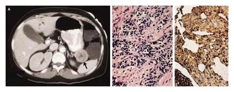 VIPoma | NEJM