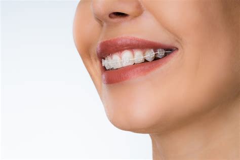 Clear Braces Southbourne - Teeth Aligners Bournemouth