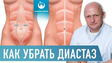 ДИАСТАЗ (расхождение) прямых мышц живота. Причины, осложнения, лечение ...