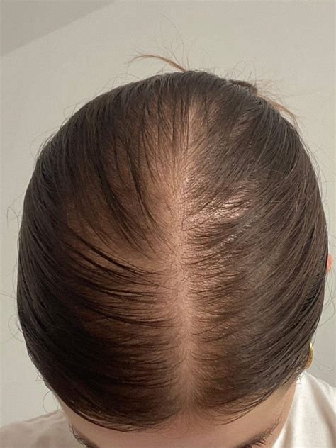 Ist das haarausfall oder normal? (Haarpflege, Kopfhaut)