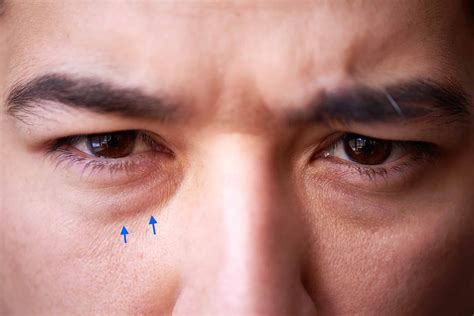 eye bags under eyes 4