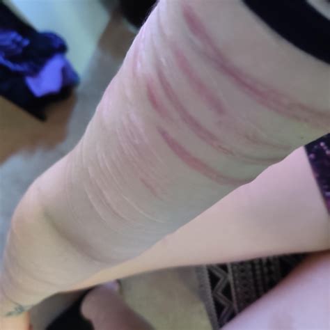 Why do I love my scars so much? : r/SelfHarmScars