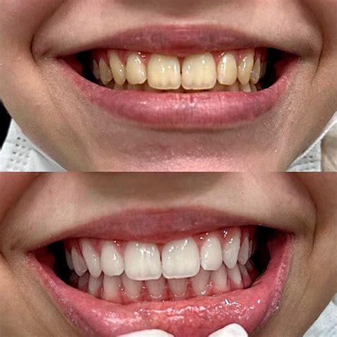 Quanto E Um Clareamento De Dentes - Clareamento Dental - Só Sorriso Odontologia | Recreio do Bandeirantes ...