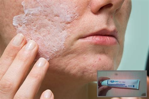 Эффезел гель – цена, отзывы, инструкция по применению от прыщей ...