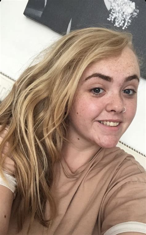 Lizzie's Story - Facial Palsy UK