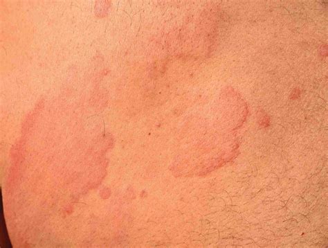 Identify Itchy Skin Rash