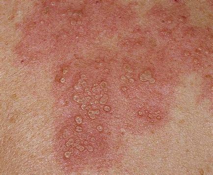 Herpes pe corpul cauzele, simptomele și tratamentul