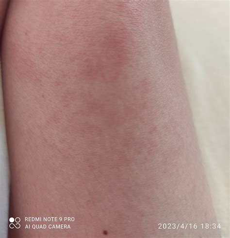 После душа бывают красные пятна по телу. Это что? - Советчица