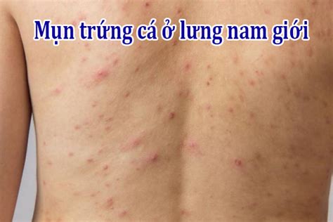 3 Cách ngăn ngừa mụn trứng cá ở lưng nam giới hiệu quả