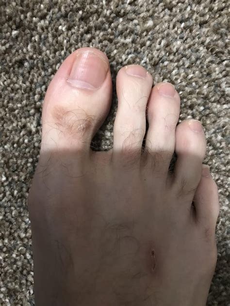 Is this crusted scabies? : r/scabies