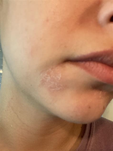 Nummular Eczema Face