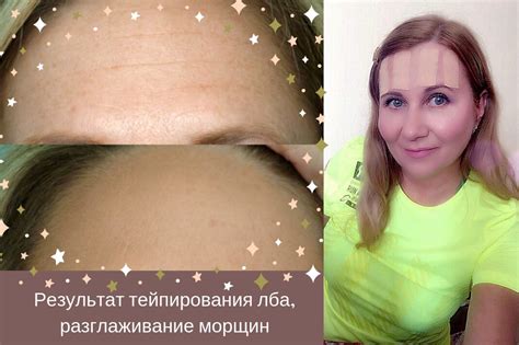 Тейпы Для Похудения Отзывы Реальные Фото — Картинки фотографии