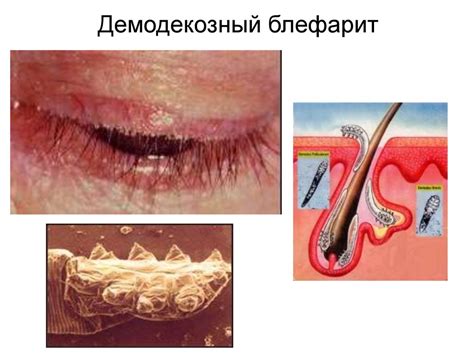 Воспалительные заболевания глаз и вспомогательного аппарата ...