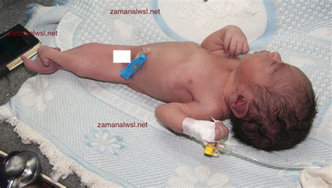Photos: Syrian newborn with Mermaid syndrome | SYRIA NEWS | ZAMAN ALWSL