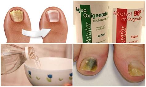 Como Combatir Hongos En Las Uñas | Moda y Estilo