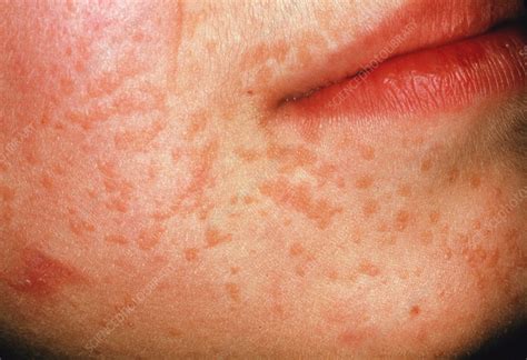 plane warts stock image  science photo library