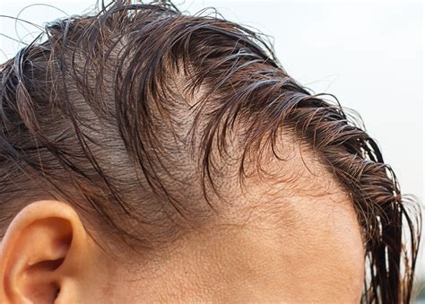 Hair loss in women: What is the best treatment? | Bio Hair Clinic