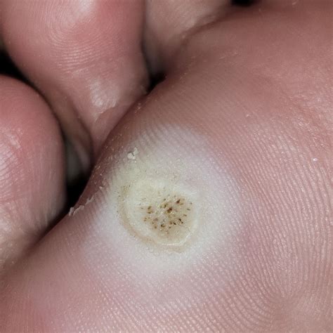 Plantar warts progress continued. : r/Warts