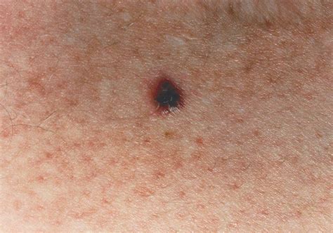 Melanoma Pictures