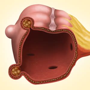 diverticulitis sugar land tx abdominal tenderness sugar land tx