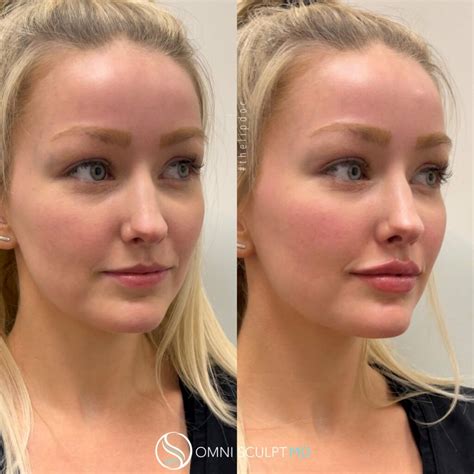 Lip Injection Before & After Gallery | OMNI SCULPT MD | Facial fillers ...
