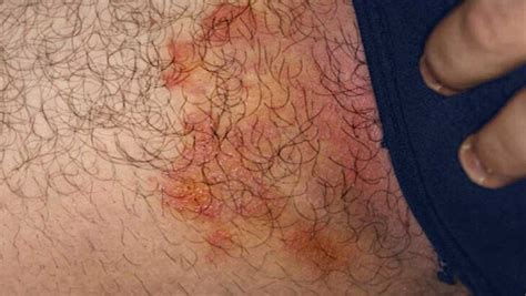 jock itch  herpes