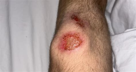 Infected knee scrape?? : r/medical_advice