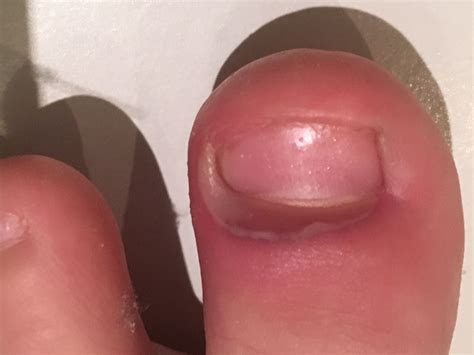 Paronychia | Nail conditions, Nails, Conditioner