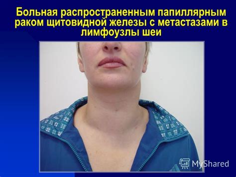Презентация на тему: "Рак щитовидной железы Проект ICRIN Тренинг для ...