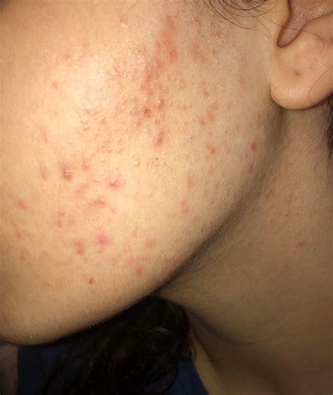 Allergie Pickeln nach Gesichtsrasur? (Haut, Pickel)