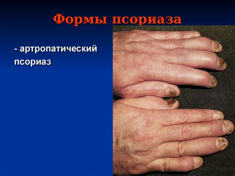 Псориаз - презентация онлайн
