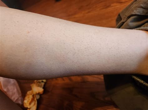 irritated legs full of ingrown hairs. How do i get rid of the and