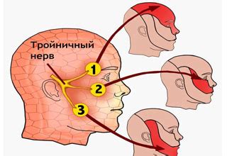 Невралгия тройничного нерва - лечение, симптомы, диагностика ...