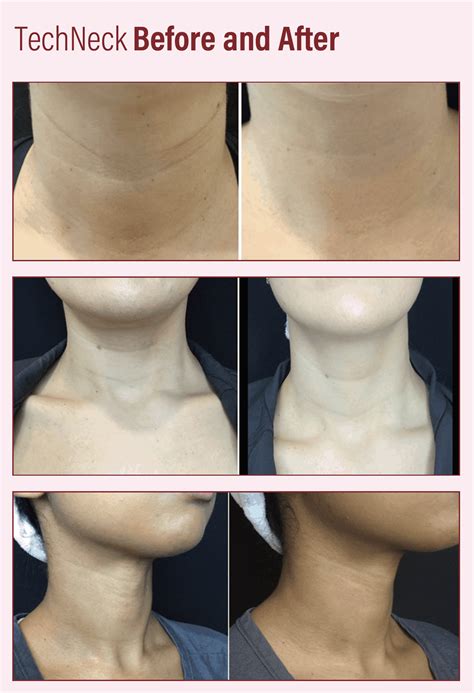 tech neck line 1
