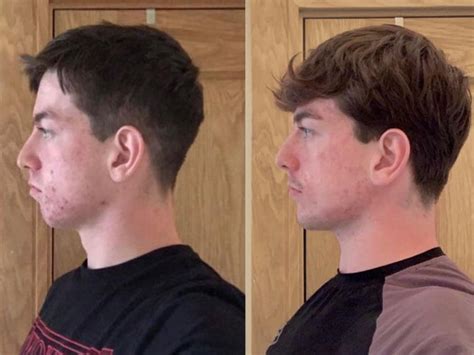 Does Mewing Change Your Face Shape And How Mewing Coa - vrogue.co