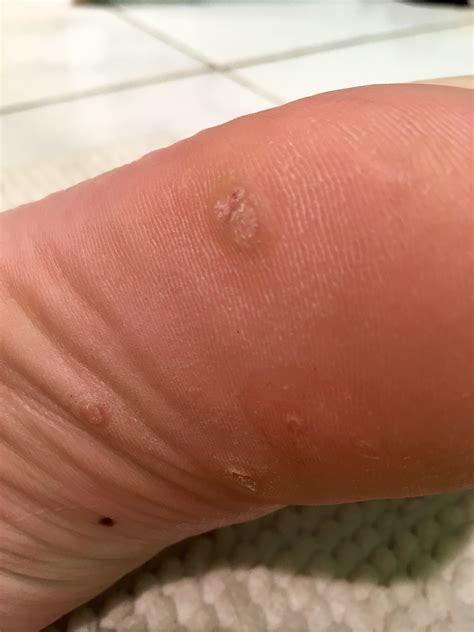 Wart situation on my foot :( just finished the first home freezing