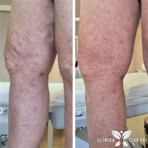 Varizes Antes E Depois Do Tratamento - Endolaser de varizes: veja o antes e depois do tratamento - Clinica Zignani