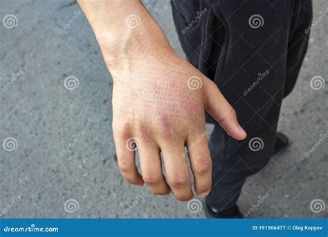 Guy`s Injured Hand. Swollen Hand Stock Image - Image of bandage