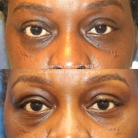 endoscopic orbital decompression steps  toni esser blog