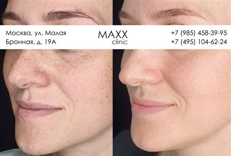 Удаление пигментных пятен в MAXX clinic